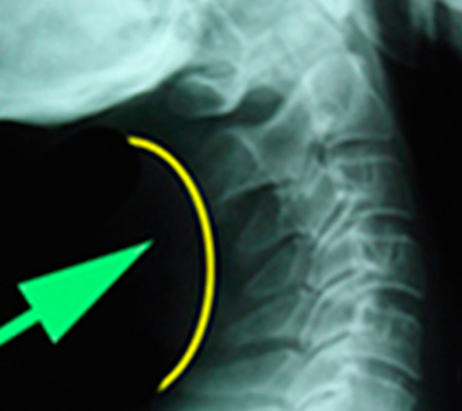 lesiones-degenerativas