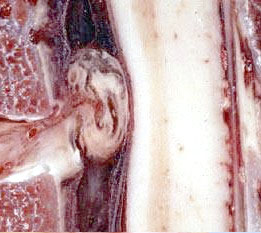hernia-discal